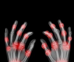 ¿Cómo mejorar el tratamiento de las enfermedades autoinmunes?