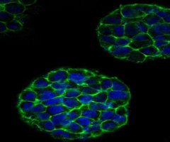 Tumores salidos de una impresora 3D ayudarán a estudiar el cáncer de cérvix